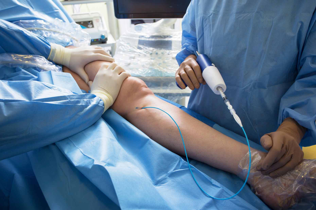 Doctor performing medical glue treatment for varicose veins at Canberra Vein Care