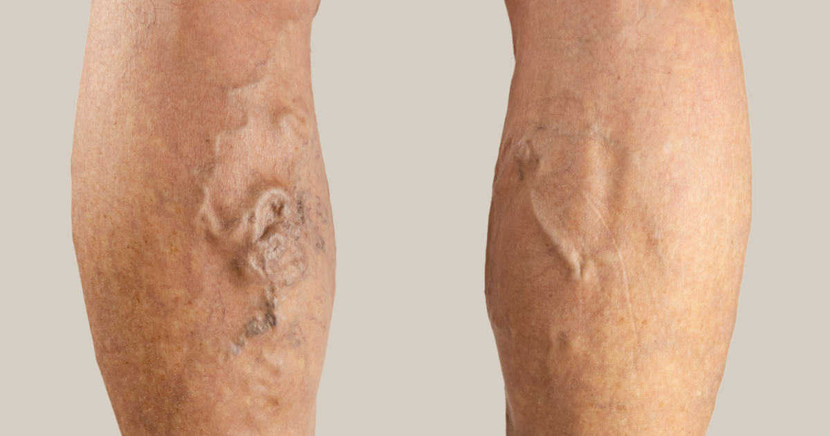 Why Is It Important to Treat Your Varicose Veins? - Vein