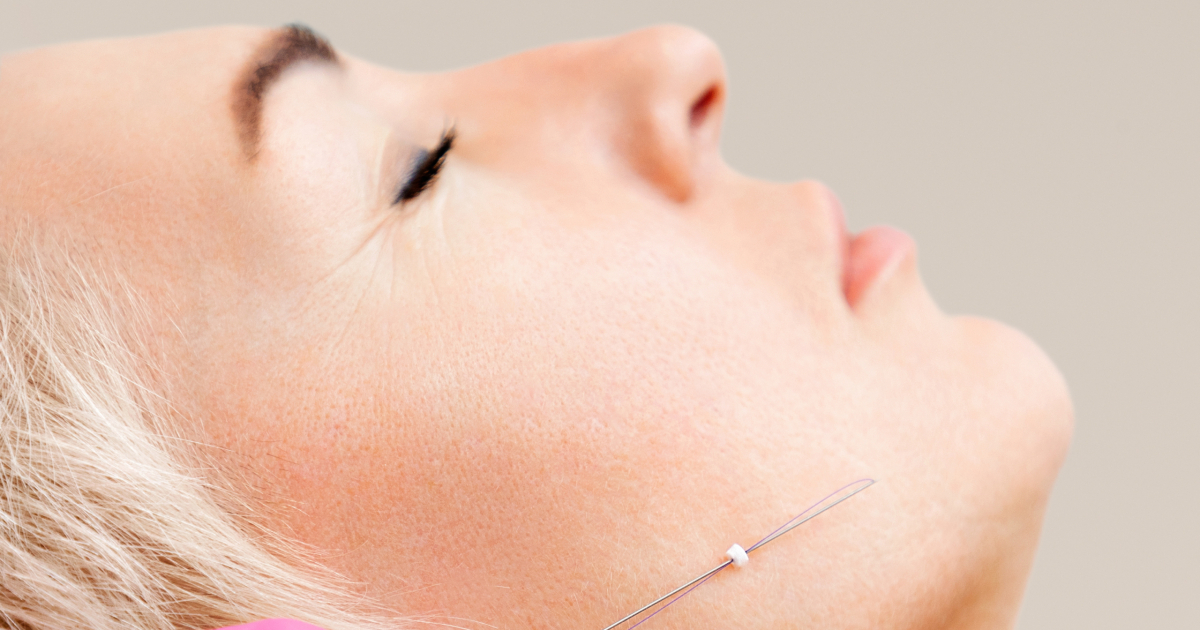 Thread Lift Canberra Facelift Clinic R Clinic
